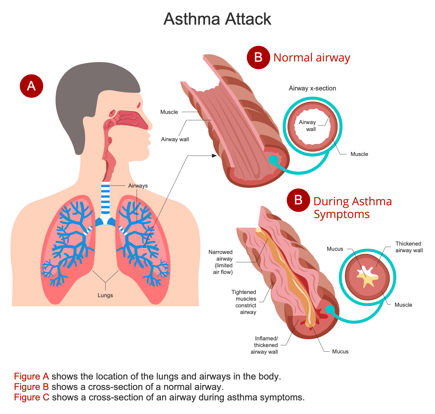 Asthma Attack